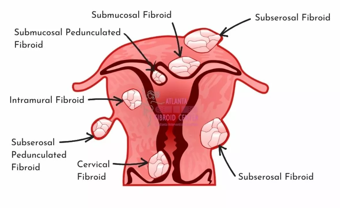 How Overgrowth in the Lining of the Uterus Can Lead to Abnormal Bleeding